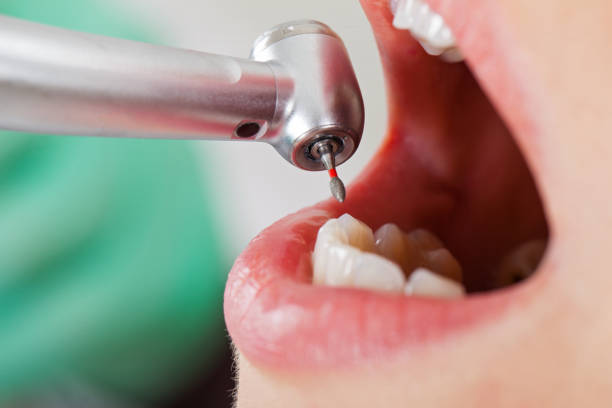 Best Emergency Dental Care for Broken or Chipped Teeth in Romoland, CA